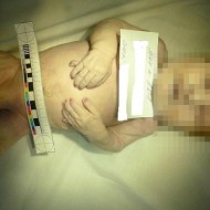 【超閲覧注意】染色体異常で死産した幼児を解剖してみた・・・　※グロ画像