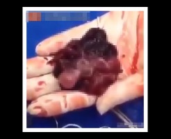 【中絶】堕ろして取り出した肉片の中で小さい生き物が動いてた・・・　※グロ動画