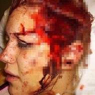 【グロ画像】警察犬に頭皮を引き裂かれた女の子　頭の皮が完全にめくれとる・・・　※閲覧注意