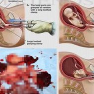 【中絶】日本で１日2000件以上行われてる中絶手術の映像はコレ　胎児さんチョキチョキ切って捨てるんやな・・・　※グロ動画