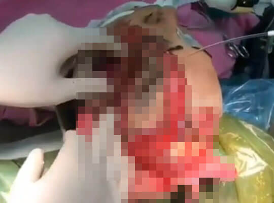 【グロ動画】交通事故で運ばれてきた女の子　顔半分の皮膚がペラペラで頭蓋骨が見えてる・・・