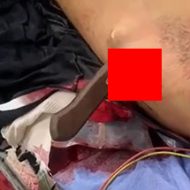 【閲覧注意】根元までズブリと刃物が刺さった男の手術映像がグロすぎる…